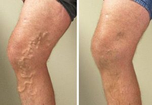 Аяқтың варикоздық ауруы - созылмалы тамырлық жүйе ауруларына жатады. Ол тамырлық қақпақшалардың жеткіліксіздігімен, қан айналымының бұзылуымен және тамырлық іркілістің дамуымен сипатталады. Бұл тіндердің гипоксиясына, ісінуге, ауырсыну синдромына және терінің трофикалық өзгерістеріне әкеледі.