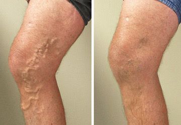 Варикозная болезнь нижних конечностей (ВБНК) относится к хроническим заболеваниям венозной системы, сопровождается несостоятельностью венозных клапанов, нарушением кровотока и развитием венозного застоя. Это приводит к гипоксии тканей, отёкам, болевому синдрому и трофическим изменениям кожи. Варикозная болезнь нижних конечностей (ВБНК) относится к хроническим заболеваниям венозной системы, сопровождается несостоятельностью венозных клапанов, нарушением кровотока и развитием венозного застоя. Это приводит к гипоксии тканей, отёкам, болевому синдрому и трофическим изменениям кожи.